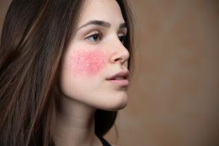Růžovka je nepříjemné kožní onemocnění zapříčiněné hlavně geny.