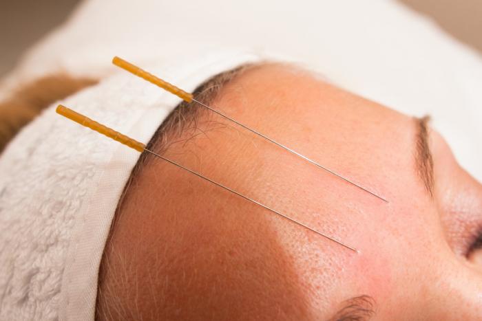 Akupunktura prý obvykle nebolí.